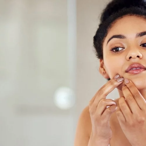 Τα μικρά άσπρα σπυράκια στο πρόσωπό σου δεν είναι (ακριβώς) ακμή