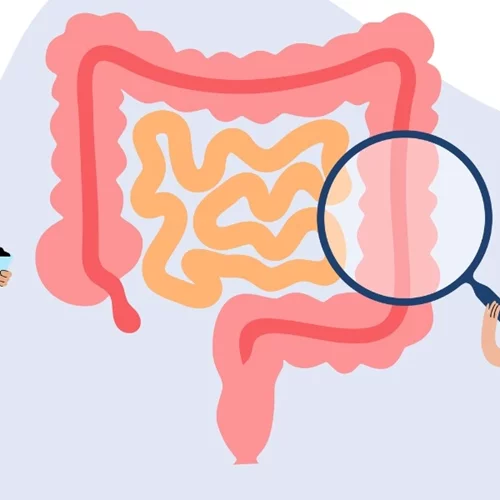 Τι είναι το self test για τον καρκίνο του εντέρου και πώς λειτουργεί