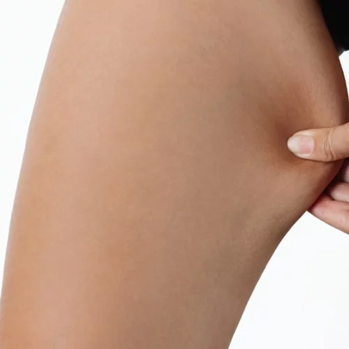 Εσωτερικό μηρών: Οι τροφές που συνδέονται με περισσότερο με λίπος στην περιοχή