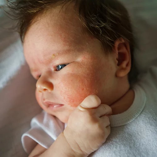 Ατοπική δερματίτιδα: Ποιοι κίνδυνοι απειλούν τα παιδιά