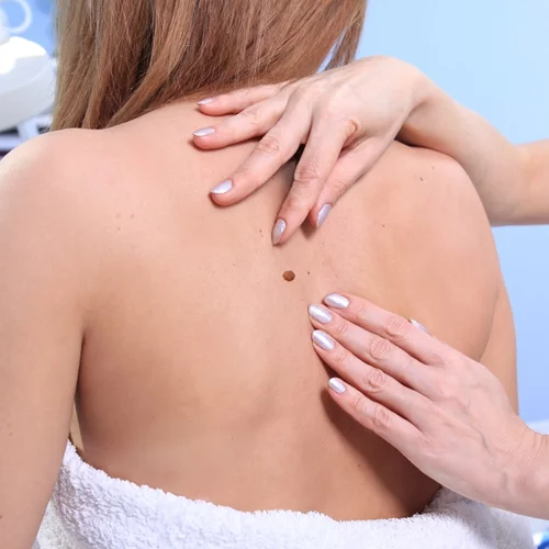 Καρκίνος του δέρματος: Πώς να προλάβεις το μελάνωμα