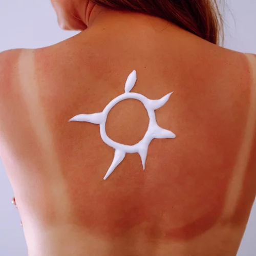 Πώς να θεραπεύσεις γρήγορα το ηλιακό έγκαυμα | Οδηγίες από δερματολόγο