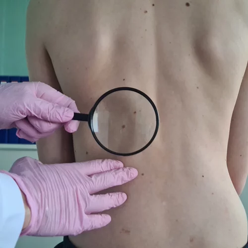 Ελιές στο δέρμα: Τι είναι η χαρτογράφηση σπίλων;