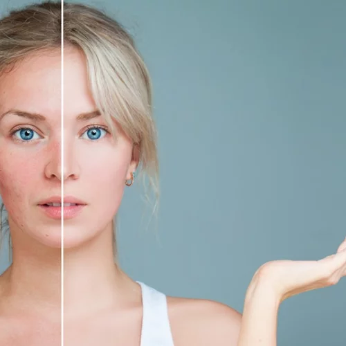 Τι είναι η ροδόχρους νόσος από την οποία πάσχει η Μαίρη Συνατσάκη;