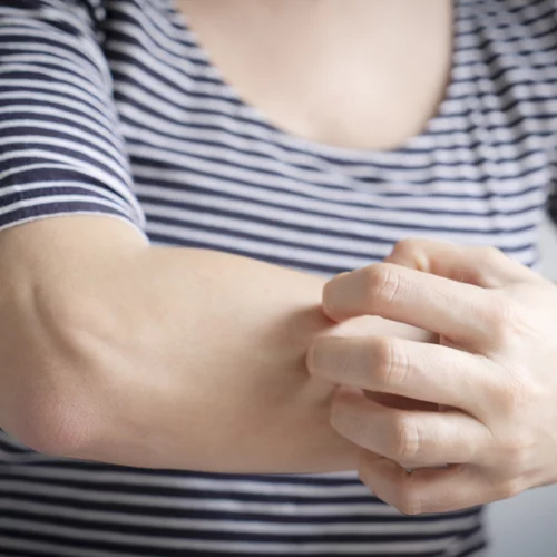 6 τρόφιμα που καταναλώνεις και αυξάνουν τις πιθανότητες να σε τσιμπήσουν τα κουνούπια