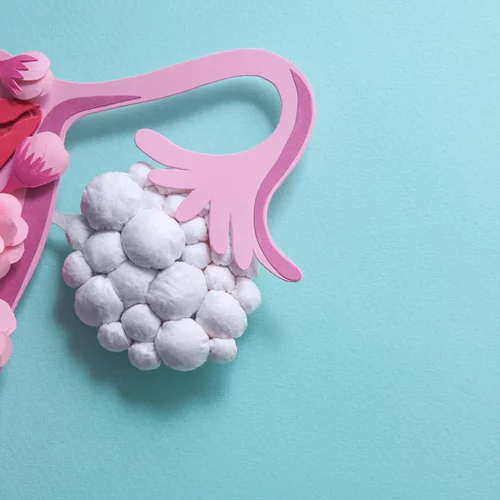 Έχεις πολυκυστικές ωοθήκες; Κάνε αυτό που προτείνει ελληνική έρευνα