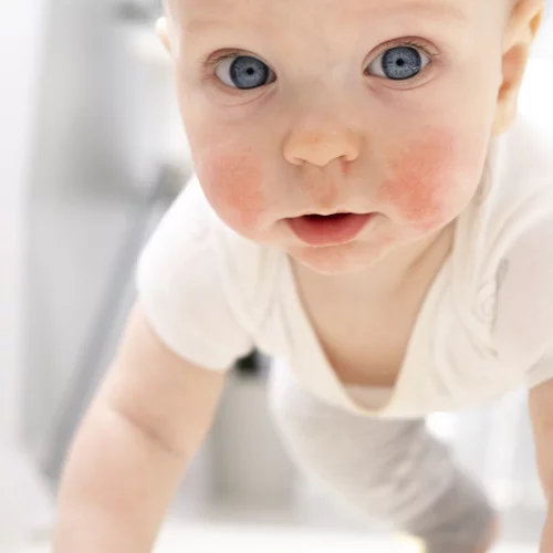 Ατοπική δερματίτιδα: Μπορεί ένα εμβόλιο να τη θεραπεύσει;