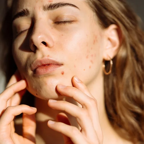 Προβιοτικά: Μπορούν να σε βοηθήσουν να "ξεφορτωθείς" την ακμή;