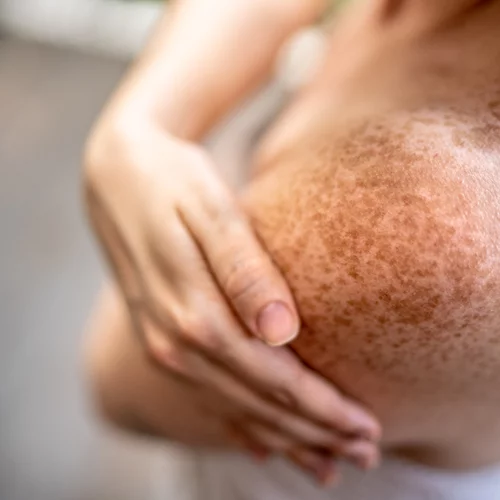 Μπορούν οι φυτικές ίνες στη διατροφή σου να σε προστατεύσουν από δερματικές παθήσεις;