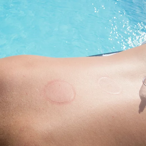 Ολυμπιακοί αγώνες 2024 | Οι βεντούζες τελικά μειώνουν τον πόνο;