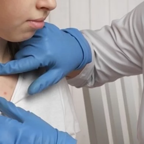 Έκρηξη των κρουσμάτων ιλαράς και στην Ελλάδα: Πώς μεταδίδεται και ποιες ηλικίες θέλουν προσοχή