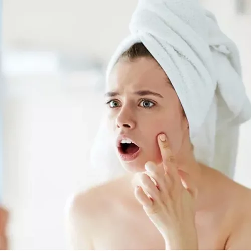 Ακμή; 5 tips για να ξεκινήσεις να την αντιμετωπίζεις από σήμερα κιόλας