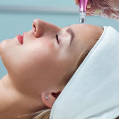 Microneedling με εξωσώματα: Τι προσφέρει στο δέρμα αυτή η επαναστατική θεραπεία;