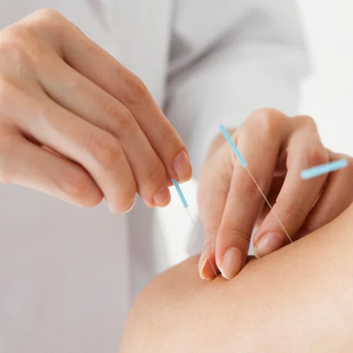 Όσα θέλεις να ξέρεις για τον κοσμητικό βελονισμό