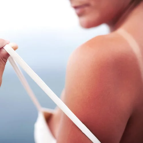 5 τροφές που νικούν κυστίτιδα, έρπη, ημικρανίες, εγκαύματα και αλλεργική ρινίτιδα