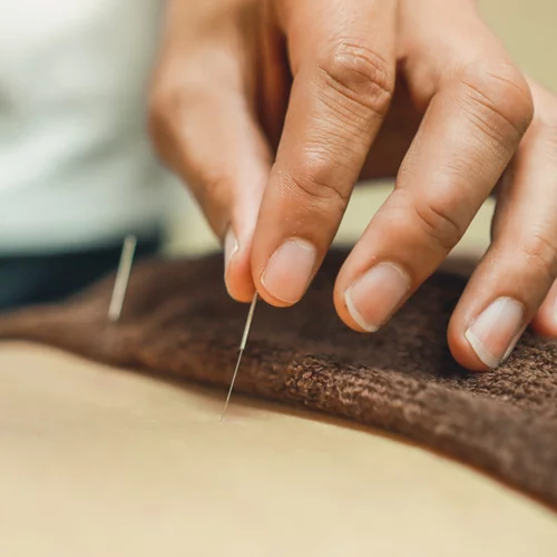 Πώς μπορεί ο βελονισμός να βοηθήσει την αισθητική και το αδυνάτισμα;