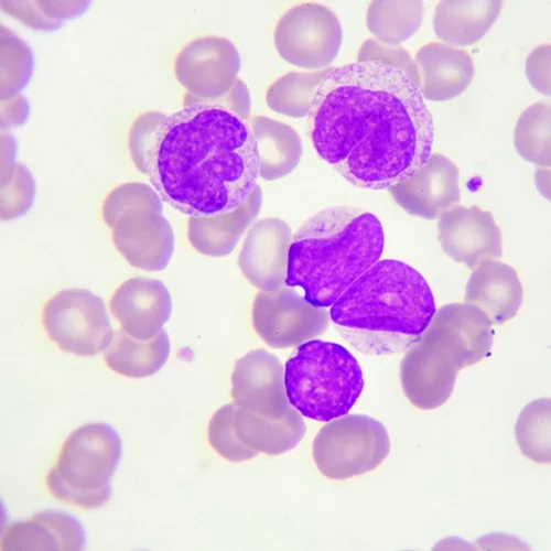 Τι πρέπει να γνωρίζεις για την Χρόνια Λεμφοκυτταρική Λευχαιμία (ΧΛΛ)