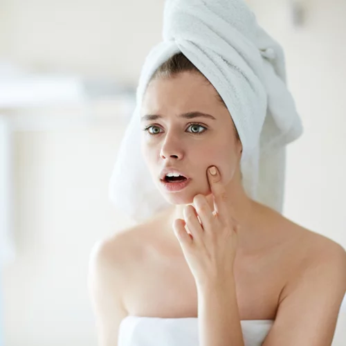 Πώς να σπάσεις ένα σπυράκι στο σπίτι (αυτό εγκρίνει η δερματολόγος)