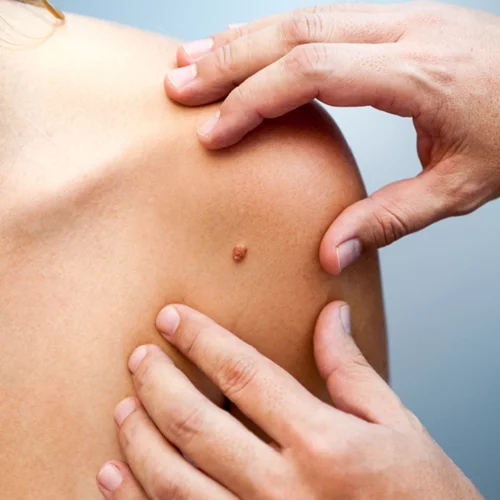 Καρκίνος των πνευμόνων, του δέρματος και άλλα είδη: Οι 3 κινήσεις για πρόληψη