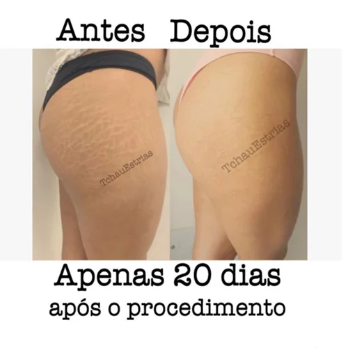 Φεύγουν οι ραγάδες με... τατουάζ; Αυτός ο tattoo artist το κάνει!