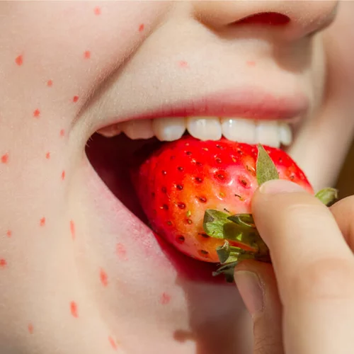 Τροφικές αλλεργίες στα παιδιά: Πότε είναι επικίνδυνες; Τι να κάνεις;