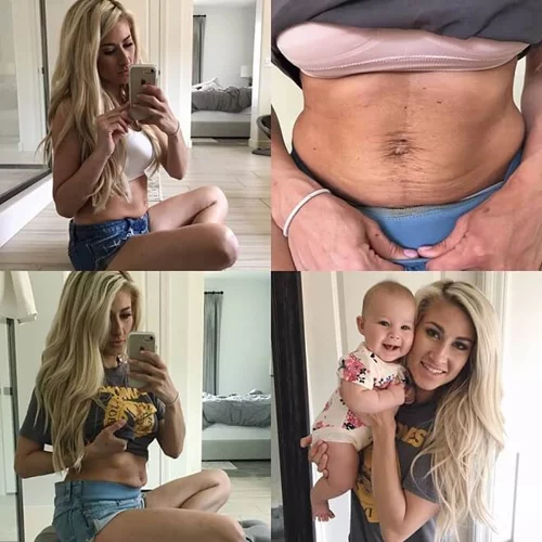 Πώς είναι η κοιλιά μιας γυμνάστριας μετά από δύο εγκυμοσύνες και γέννες