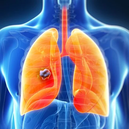 Πώς η ανοσοθεραπεία βοηθάει στην αντιμετώπιση του προχωρημένου καρκίνου του πνεύμονα