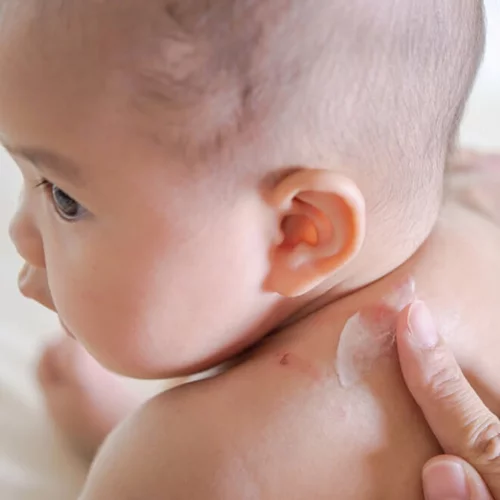 Ατοπική δερματίτιδα: Τι είναι το αλλεργικό έκζεμα