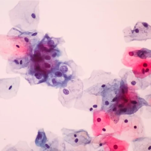 «Nα ανησυχώ για μόλυνση από τον ιό των κονδυλωμάτων (HPV);»