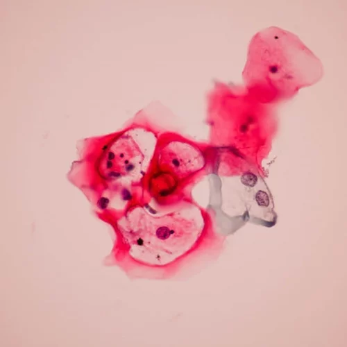 «Μην αργήσεις!» τον εμβολιασμό της κόρης σου για τον ιό HPV