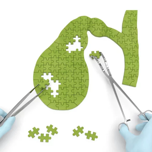 Πέτρες στη χολή: Πρέπει να τις αφαιρούμε ακόμη κι αν δεν έχουμε ενοχλήσεις;