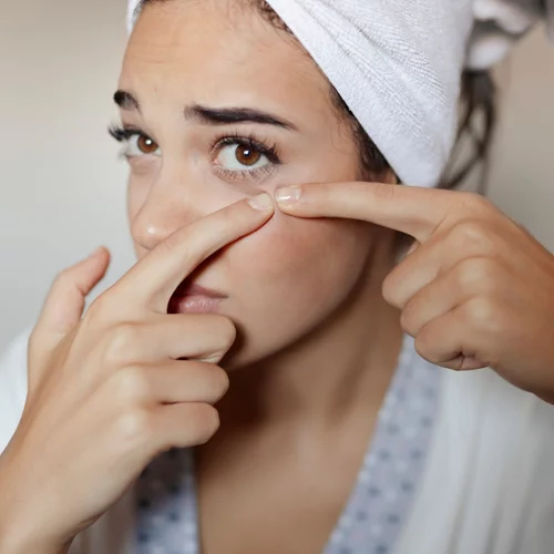 Ποια είναι η θεραπεία για την ακμή; Η δερματολόγος απαντά