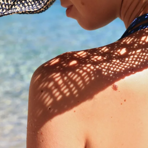 Μεταστατικό μελάνωμα: Τι είναι και τα νέα δεδομένα για τη θεραπεία του
