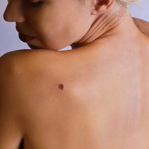 Μελάνωμα: Τι να προσέχεις και πώς αντιμετωπίζεται
