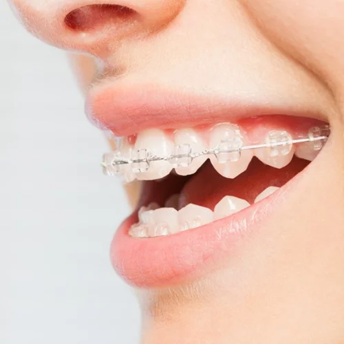 Σιδεράκια για ενήλικες: Ποτέ δεν είναι αργά!