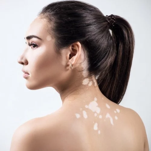 Η λεύκη στο δέρμα θεραπεύεται! Μάθε τα νέα δεδομένα