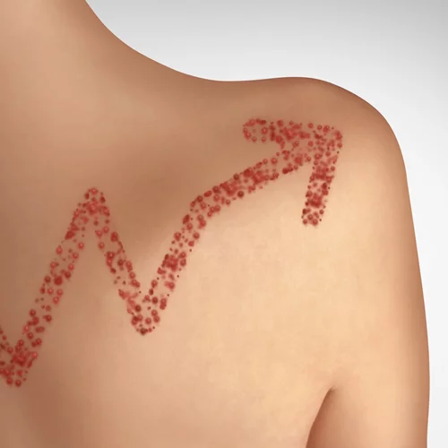 Ιλαρά 2019 Update: Μάθε πώς επηρεάζει το ανοσοποιητικό σου σύστημα