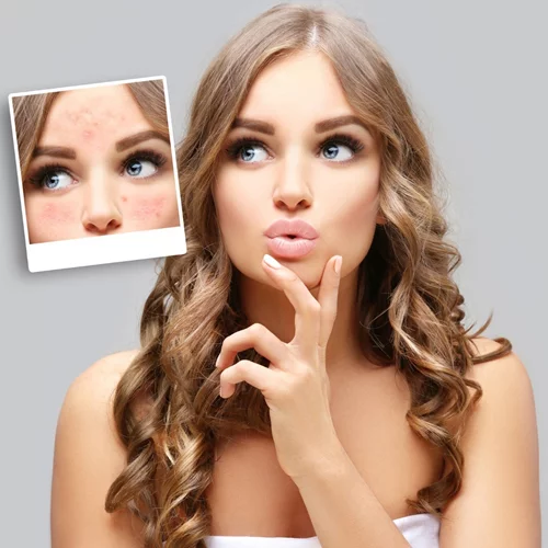 Τι είναι η ροδόχρους ακμή; 6 facts για τη νόσο από την οποία πάσχει η Σοφία Φαραζή