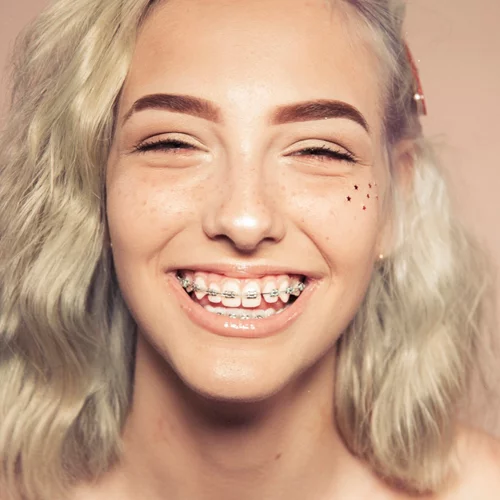 Σιδεράκια για ενήλικες: Τι προσφέρουν και τι επιλογές υπάρχουν