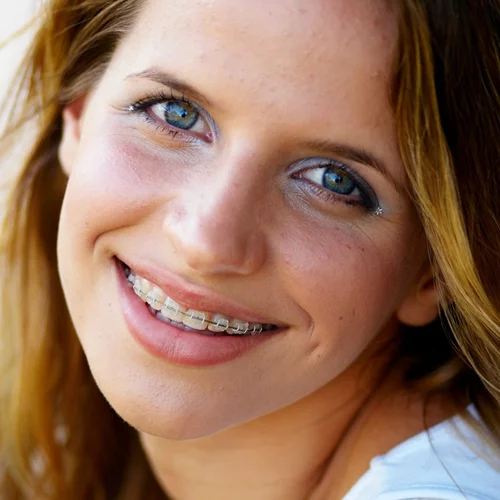 Σιδεράκια για ενήλικες: Ερωτήσεις και απαντήσεις