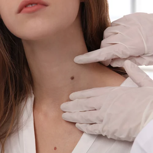 Δερματολογικός έλεγχος: Ποια είναι η καλύτερη εποχή;