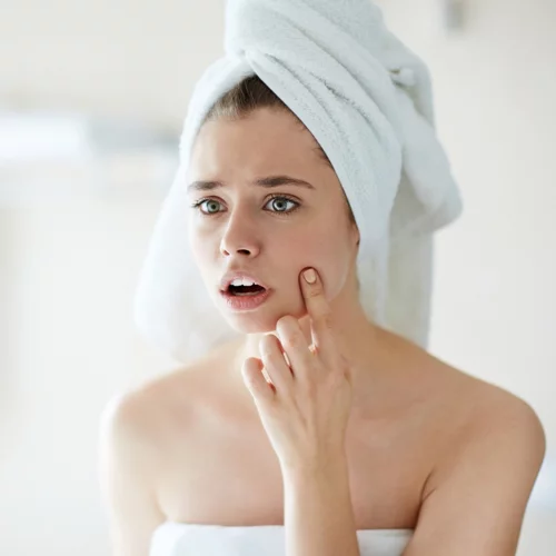 Ακμή και μετά τα 20; Δες πώς θα την αντιμετωπίσεις