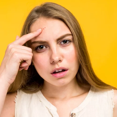 Θηλώματα του δέρματος και πώς αντιμετωπίζονται