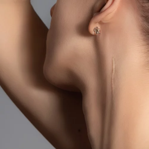 Η βιταμίνη Ε μειώνει τις ουλές;