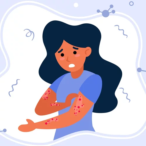 Αλλεργικές αντιδράσεις στο εμβόλιο του κορονοϊού: Σε πόσους παρουσιάζονται, τι είναι η αναφυλαξία και πώς αντιμετωπίζεται