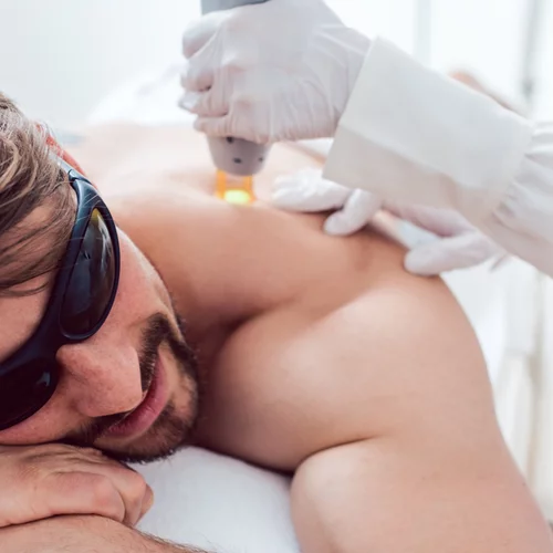 Τρεις λόγοι που οι άνδρες προτιμούν την αποτρίχωση με laser