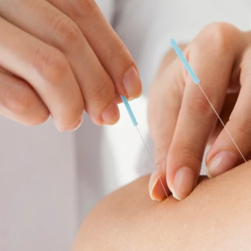 Μπορεί ο βελονισμός να βοηθήσει στην κατάθλιψη;