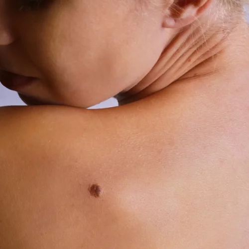 "Μία μπορεί να κάνει τη διαφορά" - 'Ωρα να κάνουμε όλοι εξέταση σπίλων