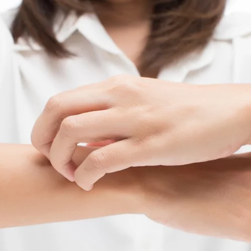 Έκζεμα στα χέρια: Ξεκινά η πρώτη κλινική μελέτη φάσης 3 για τη νόσο