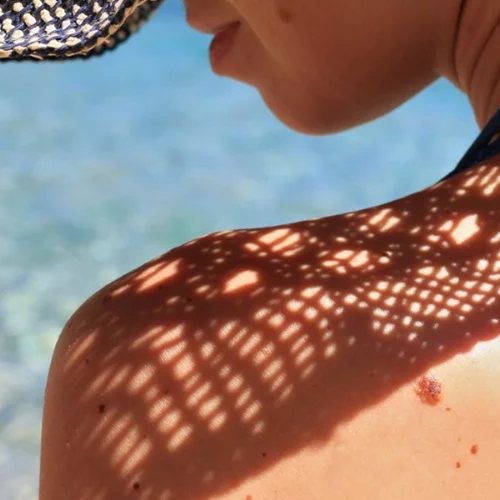 Καρκίνος του δέρματος: 4 βασικά πράγματα που πρέπει να γνωρίζεις